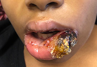 Hemorrhagic, thick, yellow crusted plaque on the lower lip